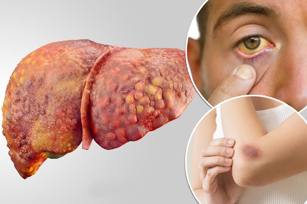 You may have serious liver damage if you experience these 5 warning signs, says the doctor